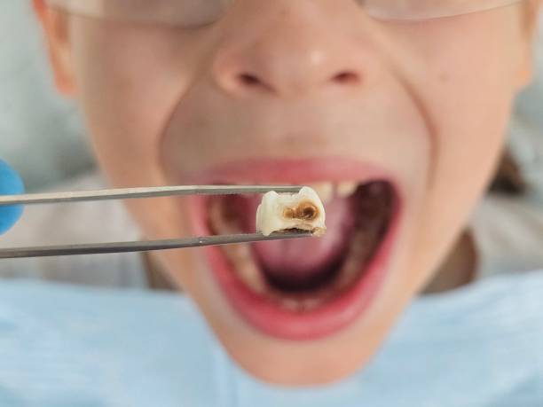 Best Dental Abscess Treatment in Oxford, GA